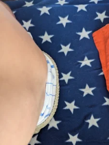 Lumbar muscle bulk - side view